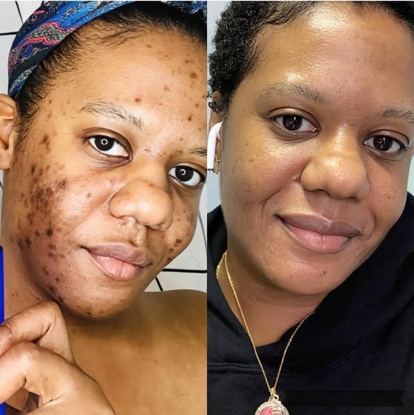 Chisom N. before and after