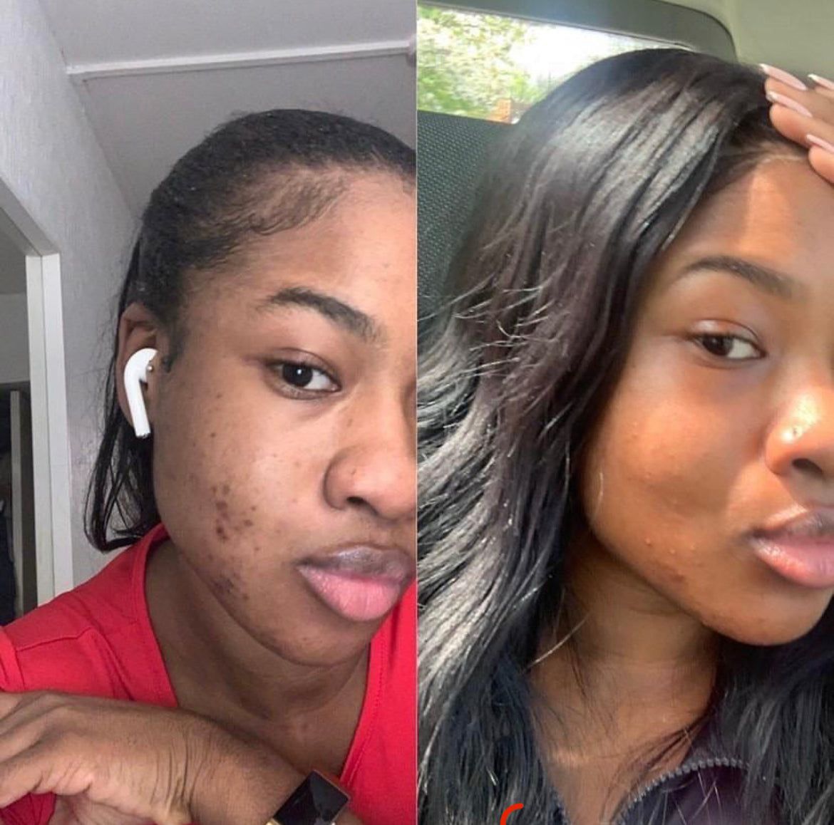 Amaka C. before and after